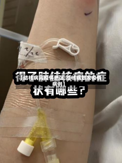 【结核病高疫情地区,结核病散发疫情病例】